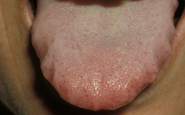 El síndrome de la boca ardiente provoca dolores en lengua y boca en pacientes
