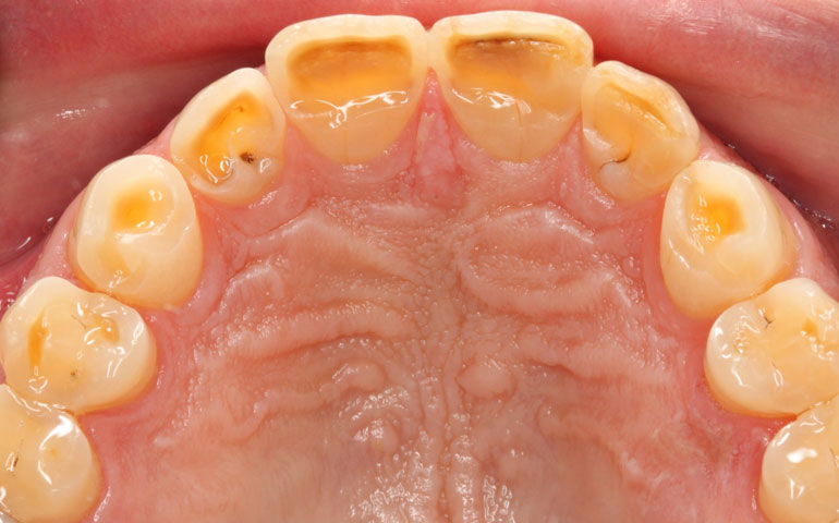 El bruxismo produce el desgaste de piezas dentales a entre el 10 y el 20% de la población