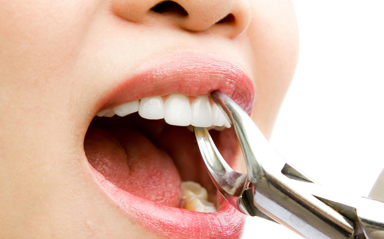Las extracciones dentales deben ser realizadas por profesionales para evitar complicaciones