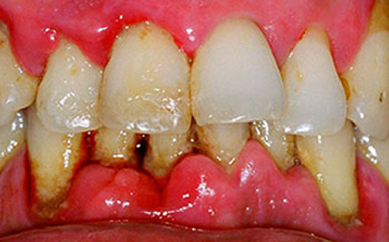 Sangrado e inflamación de las encías, síntomas más comunes de la gingivitis