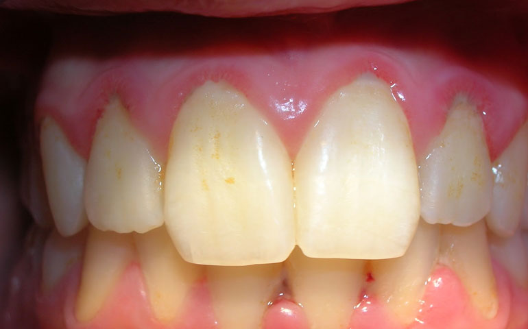 Las pigmentaciones dentales pueden ser externas (coloraciones) o internas (tinciones)